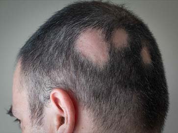 ALOPECIA TREATMENTS